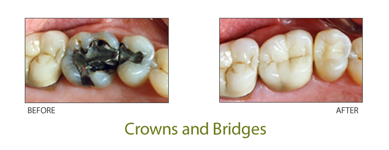 dental crowns and bridges pendleton oregon