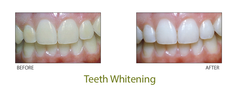 teeth whitening pendleton oregon