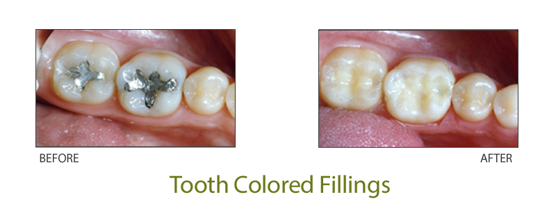 white composite fillings pendleton oregon